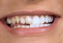 Преимущества и недостатки установки виниров на зубы